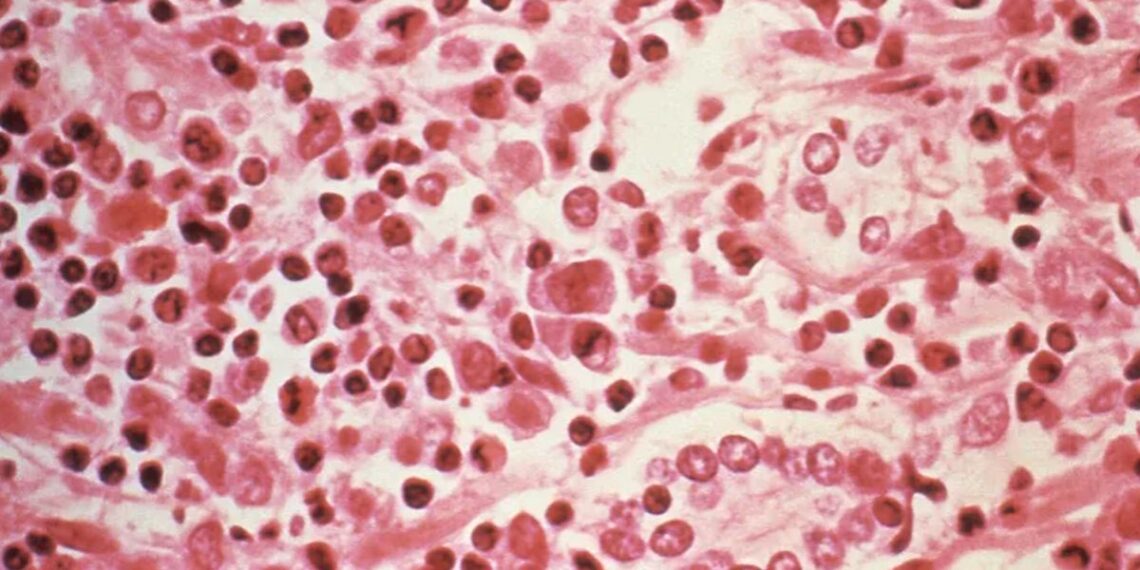 Tragedi di Kapal Pesiar Atlantik, 3 Orang Tewas Diduga Kena Wabah Hantavirus